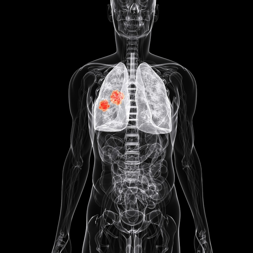 Genentech Fostering AntiPDL1 Immunotherapy in Lung Cancer