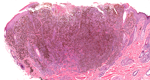 metastatic renal cell carcinoma