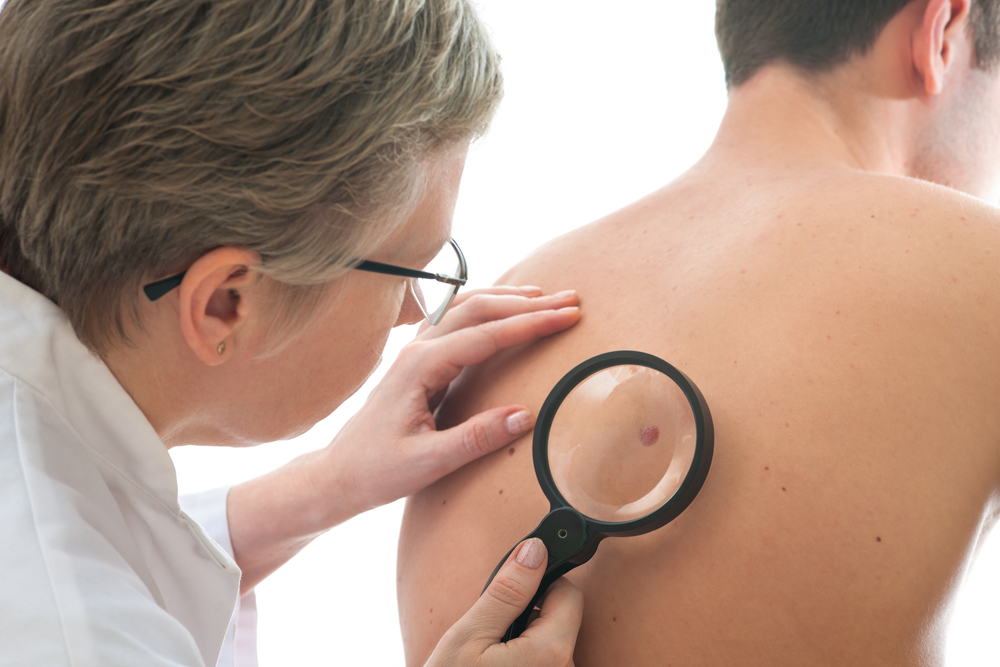 CHMP Recommends Opdivo/Yervoy Drug Combo as an Advanced Melanoma Treatment in Europe