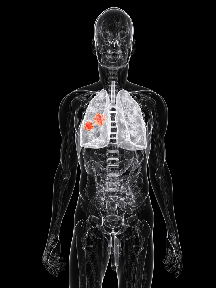 Mirati Therapeutics and MedImmune Sign Collaboration Agreement to Develop NSCLC Combination Treatment
