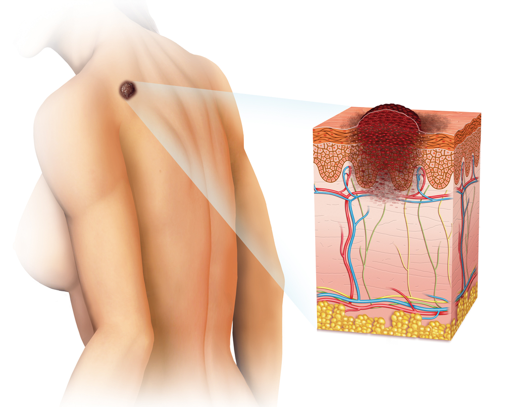 FDA Approves Yervoy as Adjuvant Therapy for Resected Stage III Melanoma