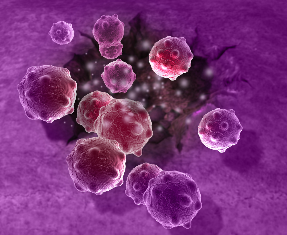 1st Multiple Myeloma Patient Being Screened as Initial Step to Testing Immune Therapy