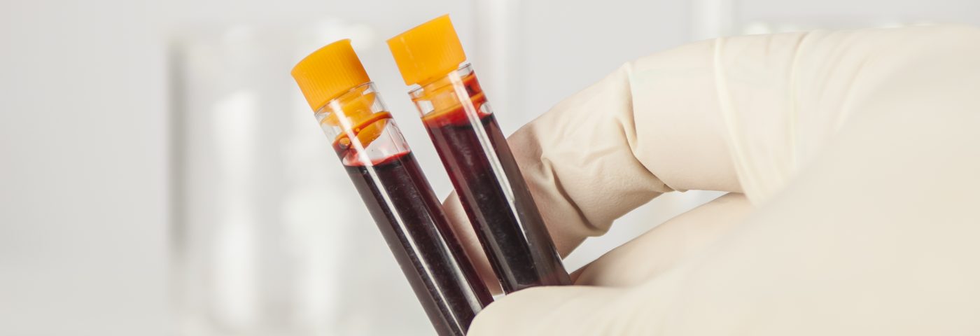 Biocept Launches PD-L1 Blood Test for Immuno-Oncology Applications