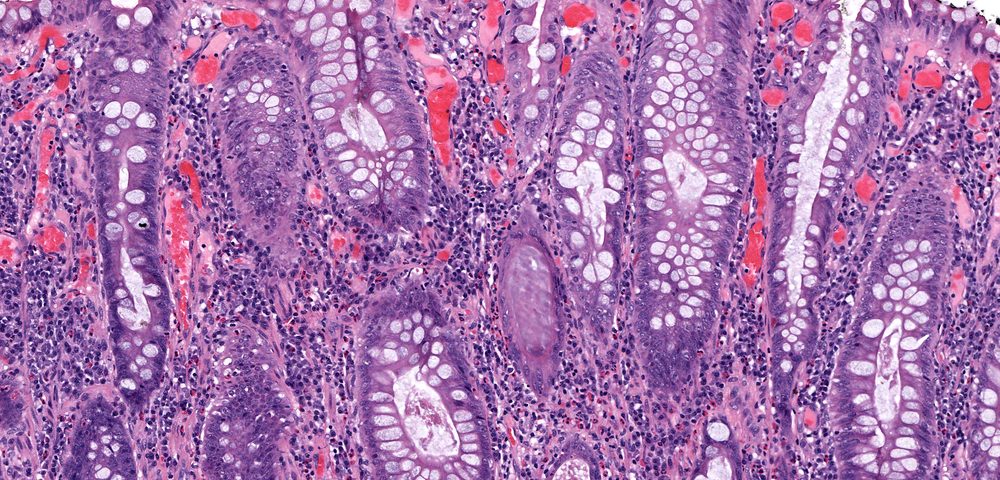 Immunotherapy Should Follow Chemotherapy in Advanced Ovarian Cancers, Study Suggests