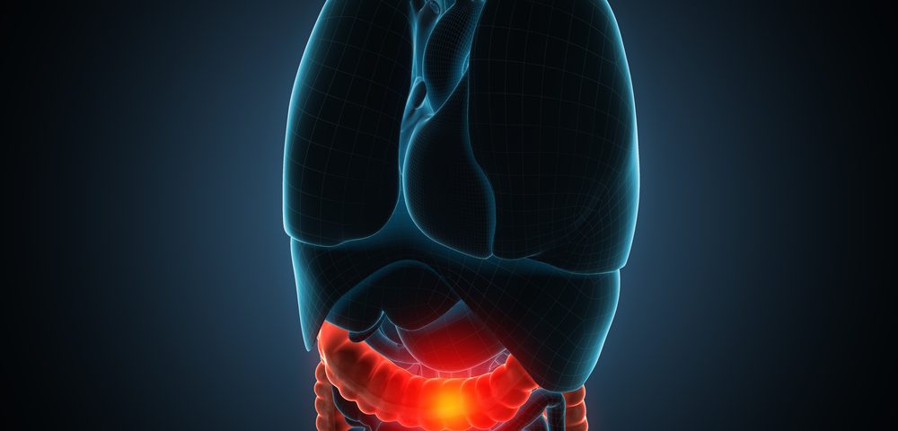 Certain Metastatic Colorectal Cancer Responsive to Combined Immunotherapy