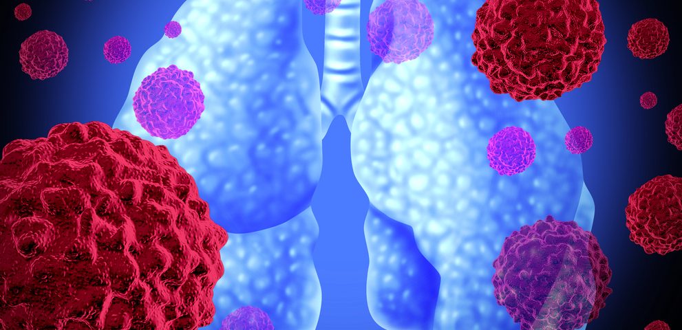 FDA Grants Priority Review to Opdivo-Yervoy Combo as First-Line Treatment for Advanced NSCLC