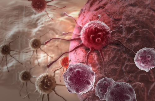 Investigational T-Cell Therapy Promising in First Liposarcoma Patients in Phase 1/2 Trial