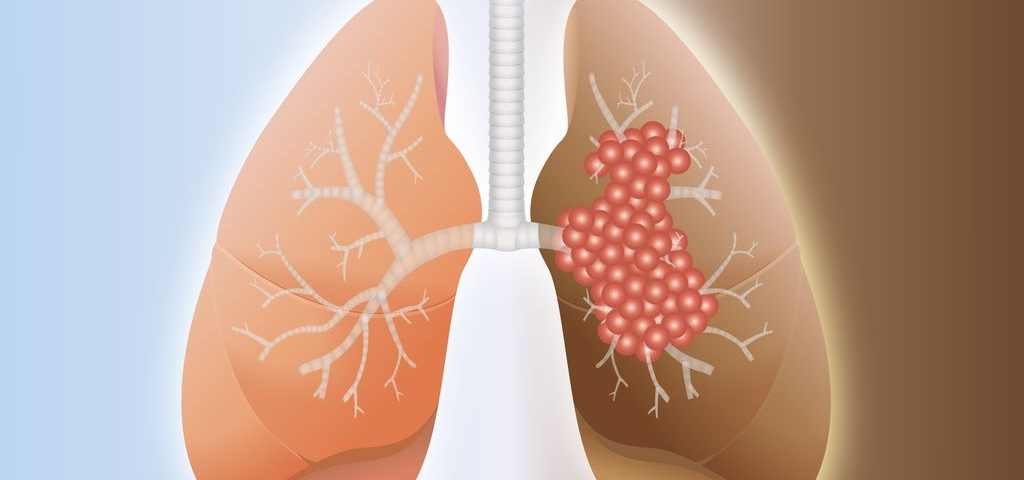 Opdivo-Yervoy Plus Shorter Chemotherapy Course Extends Survival of Patients with Advanced Lung Cancer, Early Trial Data Show